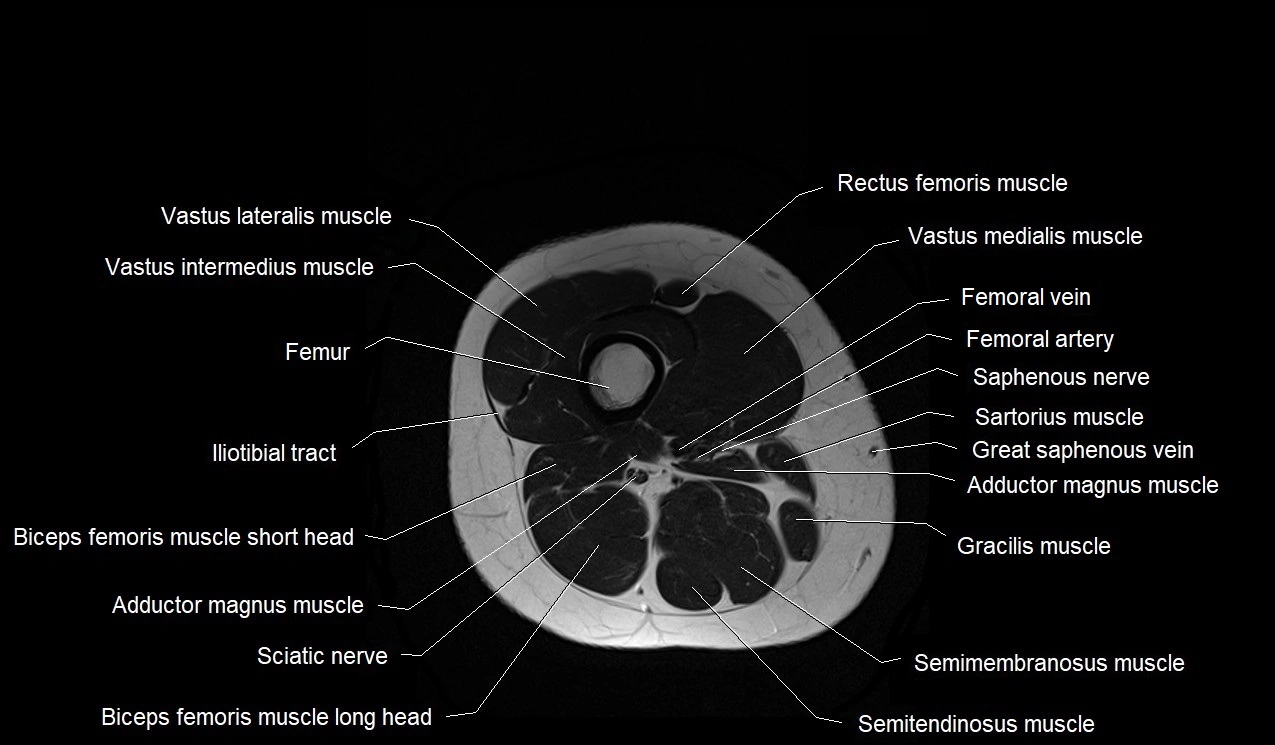 MRI thigh cross sectional anatomy image 42.webp